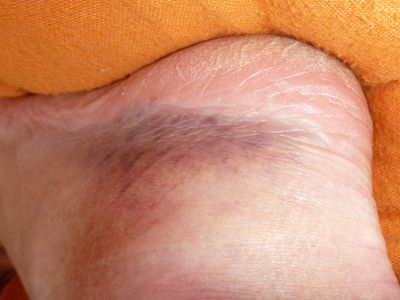 Lädierter Knöchel Lädierter Knöchel